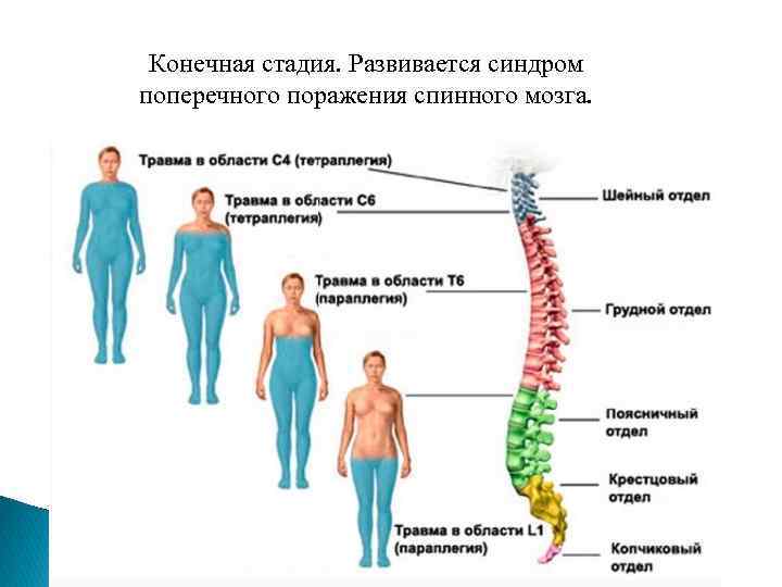 Конечная стадия. Развивается синдром поперечного поражения спинного мозга. 