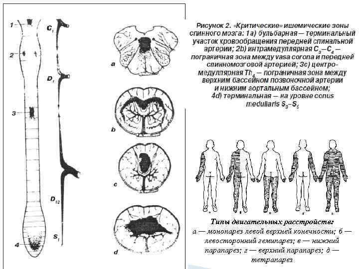 Типы двигательных расстройств: а — монопарез левой верхней конечности; б — левосторонний гемипарез; в