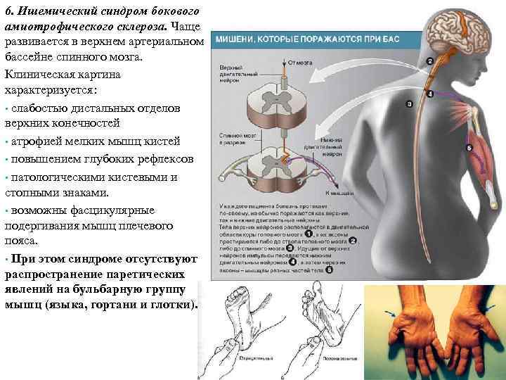 Боковой амиотрофический склероз неврология презентация