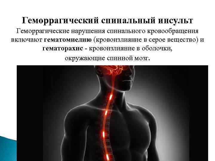 Геморрагический спинальный инсульт Геморрагические нарушения спинального кровообращения включают гематомиелию (кровоизлияние в серое вещество) и