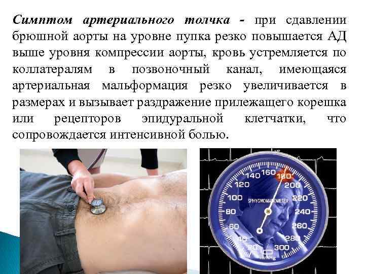 Симптом артериального толчка - при сдавлении брюшной аорты на уровне пупка резко повышается АД