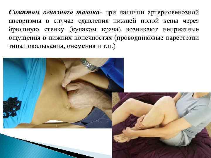 Симптом венозного толчка- при наличии артериовенозной аневризмы в случае сдавления нижней полой вены через