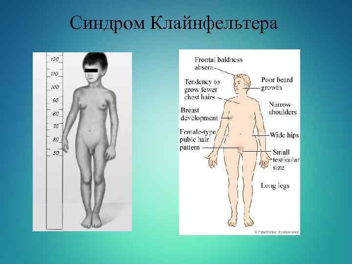 Синдром Клайнфельтера 