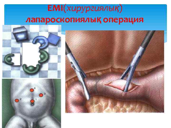 ЕМІ(хирургиялық) лапароскопиялық операция 