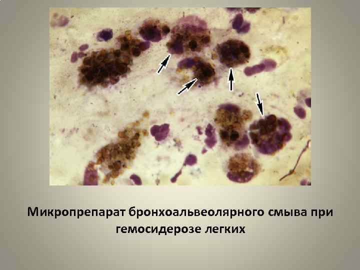 Микропрепарат бронхоальвеолярного смыва при гемосидерозе легких 