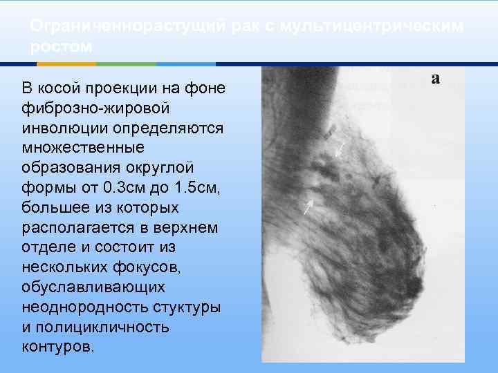 Ограниченнорастущий рак с мультицентрическим ростом В косой проекции на фоне фиброзно-жировой инволюции определяются множественные