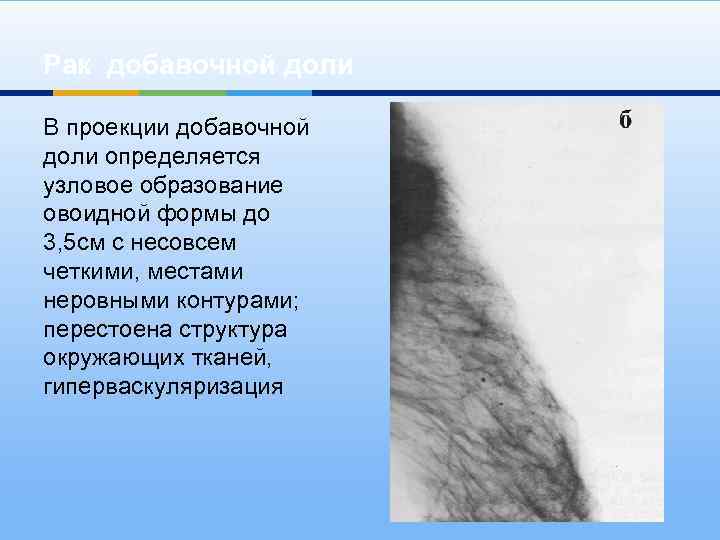 Рак добавочной доли В проекции добавочной доли определяется узловое образование овоидной формы до 3,