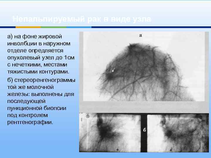 Непальпируемый рак в виде узла а) на фоне жировой инволбции в наружном отделе опредляется