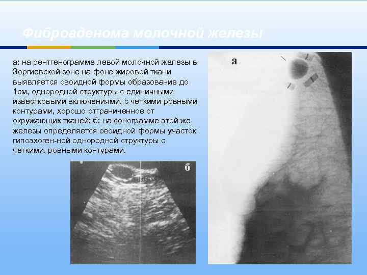 Фиброаденома молочной железы а: на рентгенограмме левой молочной железы в Зоргиевской зоне на фоне