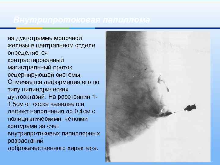 Внутрипротоковая папиллома на дуктограмме молочной железы в центральном отделе определяется контрастированный магистральный проток сецернирующей