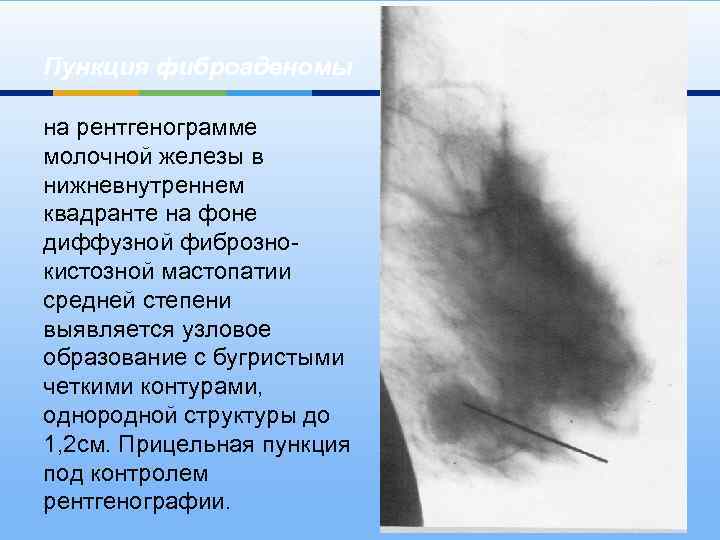 Пункция фиброаденомы на рентгенограмме молочной железы в нижневнутреннем квадранте на фоне диффузной фибрознокистозной мастопатии