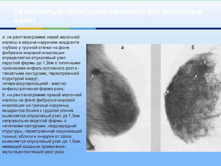 Синхронный мультицентрический рак молочных желез а: на рентгенограмме левой молочной железы в верхне-наружном квадранте