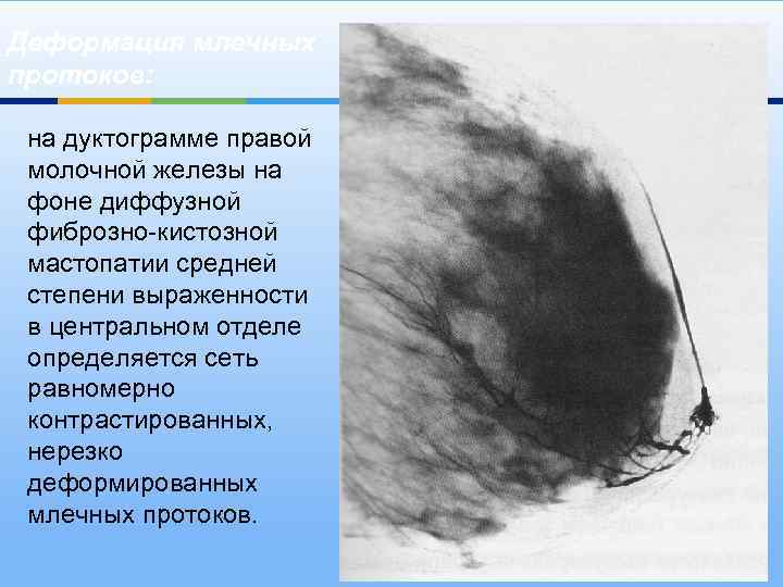 Деформация млечных протоков: на дуктограмме правой молочной железы на фоне диффузной фиброзно-кистозной мастопатии средней