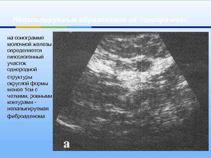 Непальпируемые образования на сонограммах на сонограмме молочной железы определяется гипоэхогенный участок однородной структуры округлой