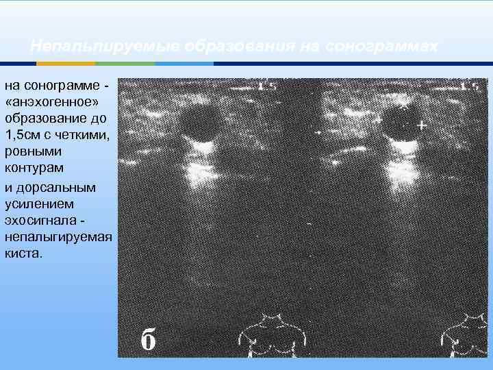 Непальпируемые образования на сонограммах на сонограмме - «анэхогенное» образование до 1, 5 см с