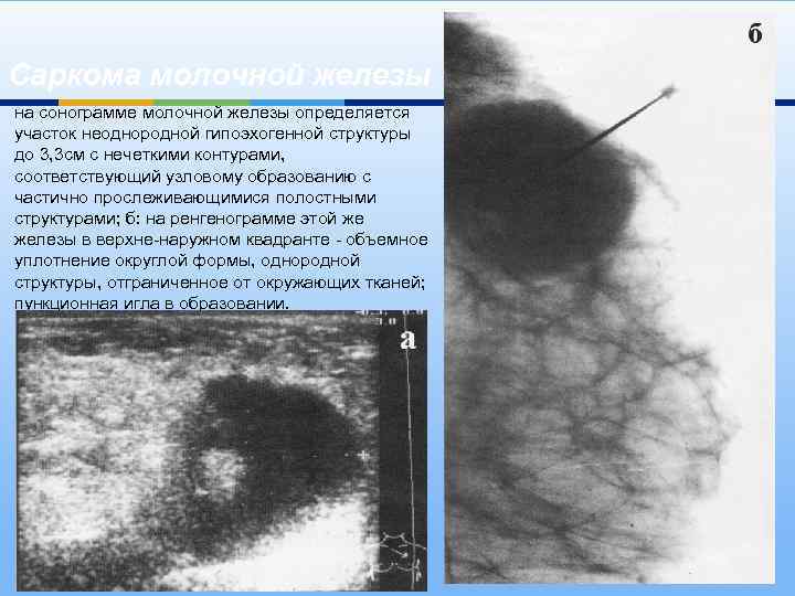 Саркома молочной железы на сонограмме молочной железы определяется участок неоднородной гипоэхогенной структуры до 3,