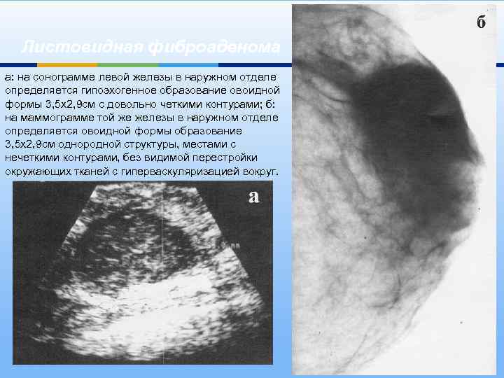 Листовидная фиброаденома а: на сонограмме левой железы в наружном отделе определяется гипоэхогенное образование овоидной