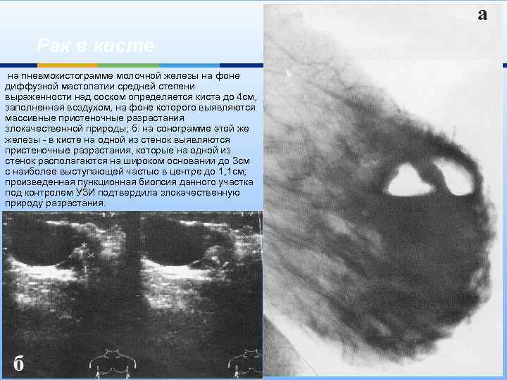 Рак в кисте на пневмокистограмме молочной железы на фоне диффузной мастопатии средней степени выраженности