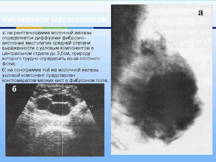 Кистозная мастопатия а: на рентгенограмме молочной железы определяется диффузная фибрознокистозная мастопатия средней степени выраженности