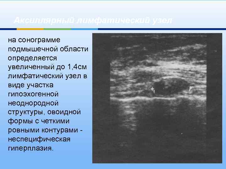 Аксиллярный лимфатический узел на сонограмме подмышечной области определяется увеличенный до 1, 4 см лимфатический