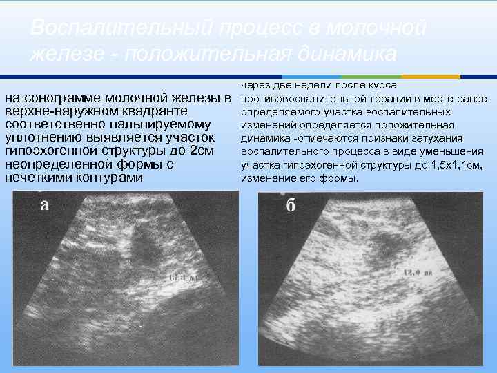 Воспалительный процесс в молочной железе - положительная динамика на сонограмме молочной железы в верхне-наружном