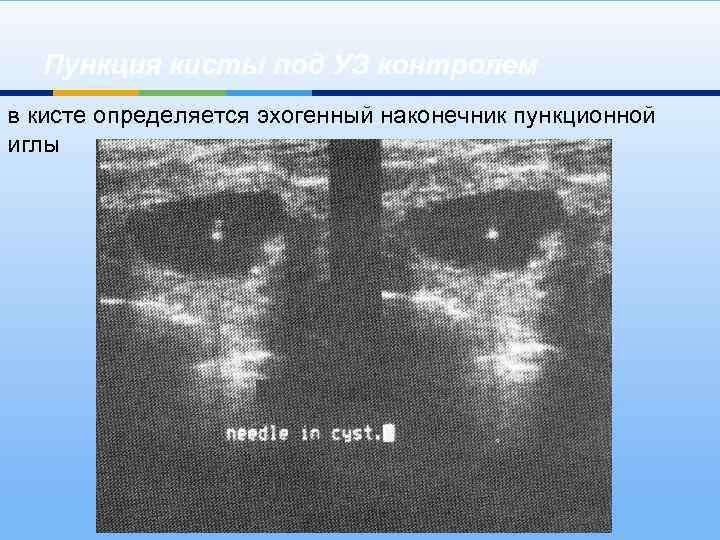 Пункция кисты под УЗ контролем в кисте определяется эхогенный наконечник пункционной иглы 