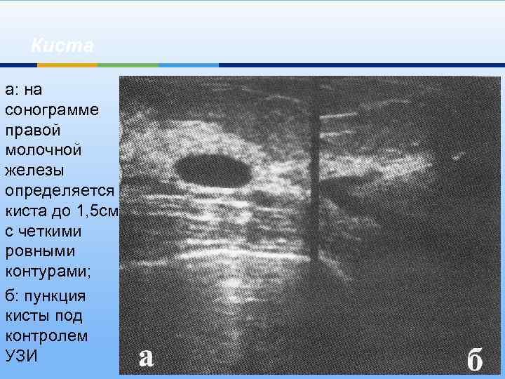 Киста а: на сонограмме правой молочной железы определяется киста до 1, 5 см с