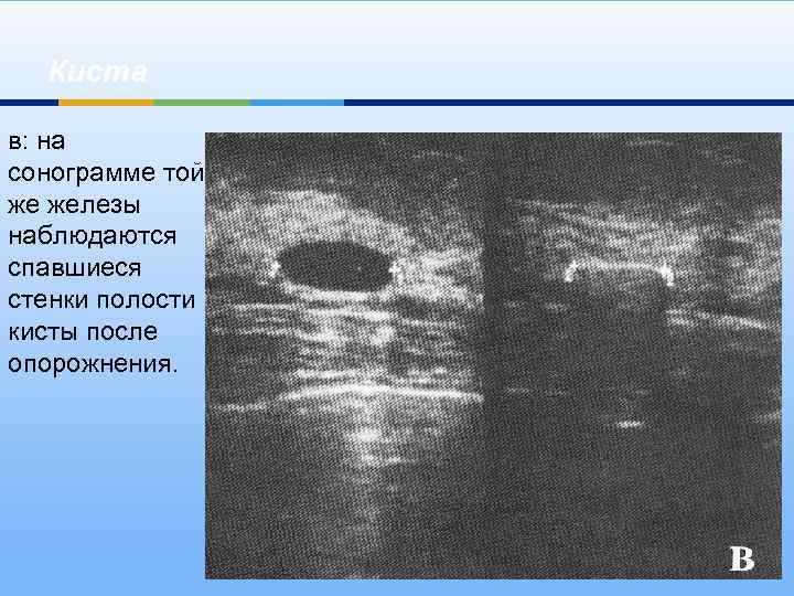 Киста в: на сонограмме той же железы наблюдаются спавшиеся стенки полости кисты после опорожнения.