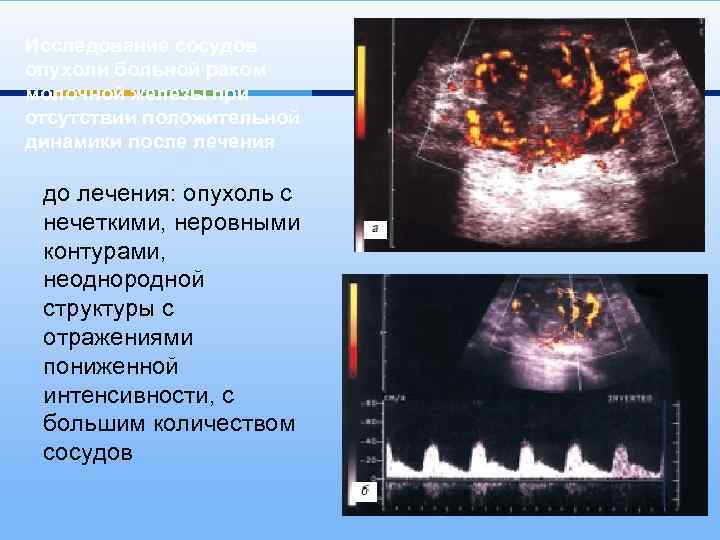 Исследование сосудов опухоли больной раком молочной железы при отсутствии положительной динамики после лечения до