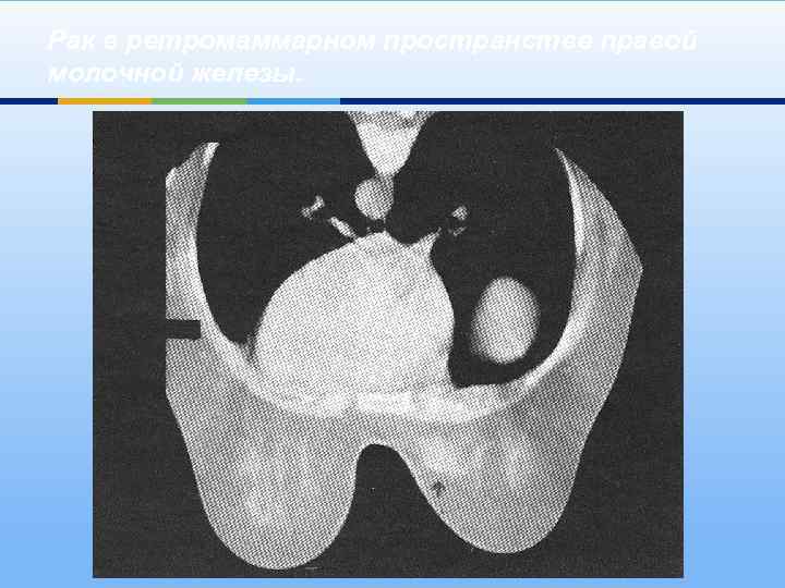 Рак в ретромаммарном пространстве правой молочной железы. 