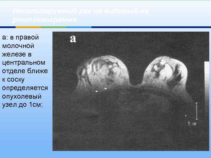 Непальпируемый рак не видимый на рентгенограмме а: в правой молочной железе в центральном отделе