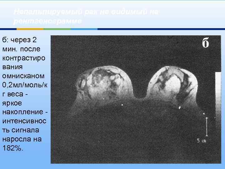 Непальпируемый рак не видимый на рентгенограмме б: через 2 мин. после контрастиро вания омнисканом