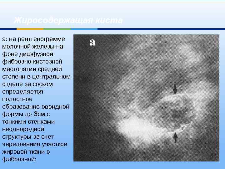 Жиросодержащая киста а: на рентгенограмме молочной железы на фоне диффузной фиброзно-кистозной мастопатии средней степени