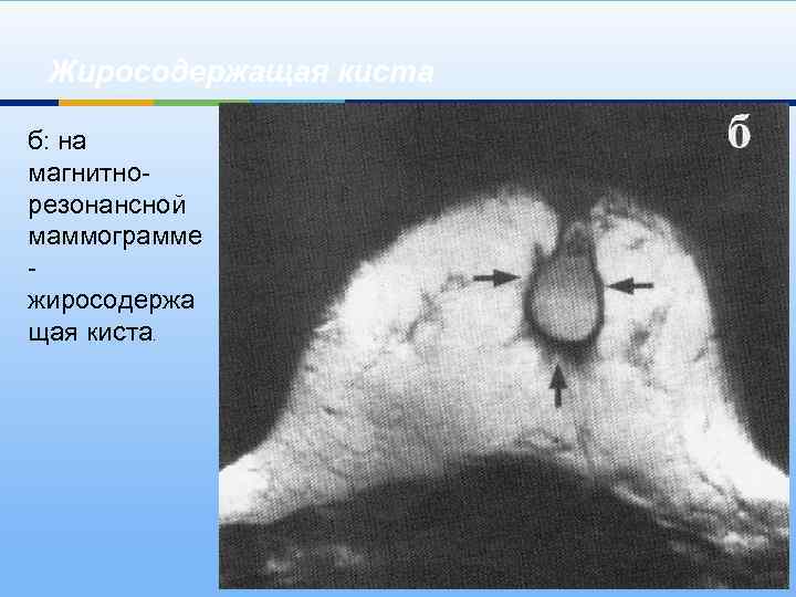 Жиросодержащая киста б: на магнитнорезонансной маммограмме - жиросодержа щая киста. 