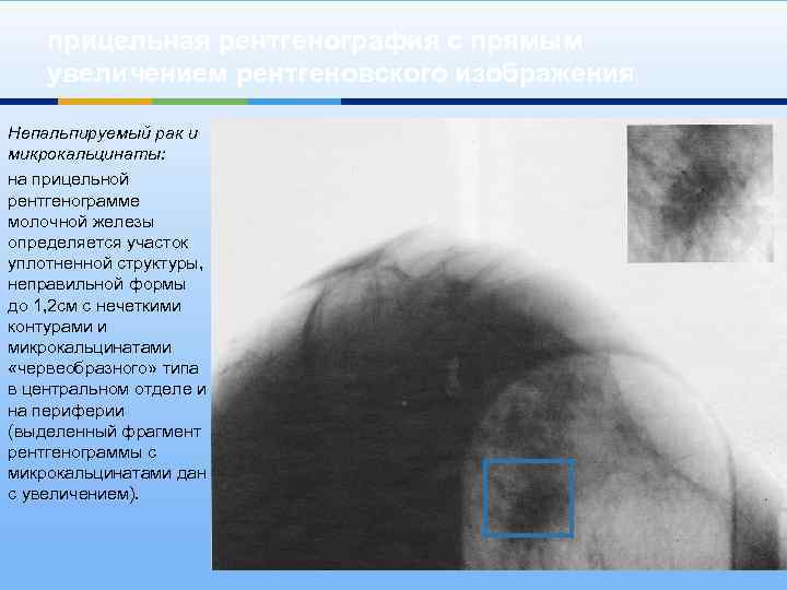 прицельная рентгенография с прямым увеличением рентгеновского изображения Непальпируемый рак и микрокальцинаты: на прицельной рентгенограмме
