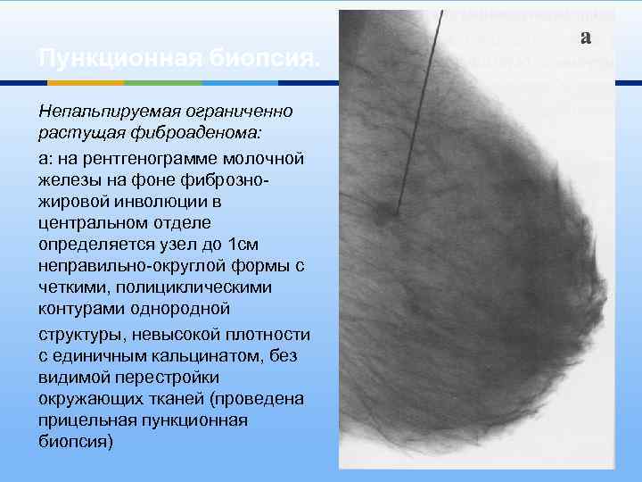 Пункционная биопсия. Непальпируемая ограниченно растущая фиброаденома: а: на рентгенограмме молочной железы на фоне фиброзножировой