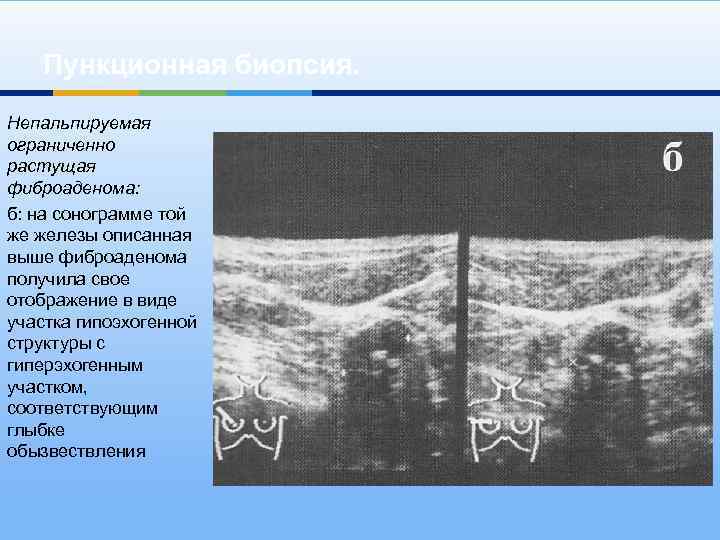 Пункционная биопсия. Непальпируемая ограниченно растущая фиброаденома: б: на сонограмме той же железы описанная выше