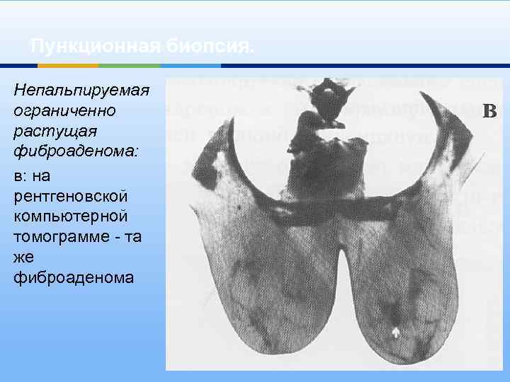 Пункционная биопсия. Непальпируемая ограниченно растущая фиброаденома: в: на рентгеновской компьютерной томограмме - та же