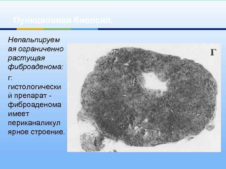 Пункционная биопсия. Непальпируем ая ограниченно растущая фиброаденома: г: гистологически й препарат - фиброаденома имеет