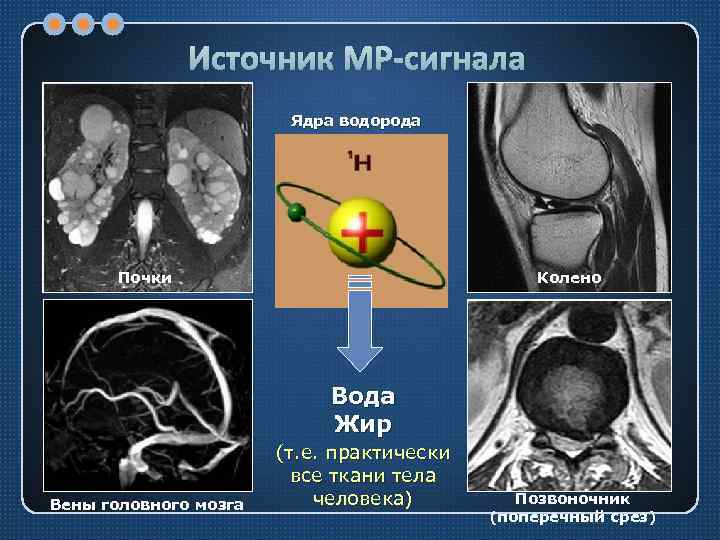 Источник МР-сигнала Ядра водорода Почки Колено Вода Жир Вены головного мозга (т. е. практически