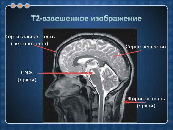 Т 2 -взвешенное изображение Кортикальная кость (нет протонов) Серое вещество СМЖ (яркая) Жировая ткань