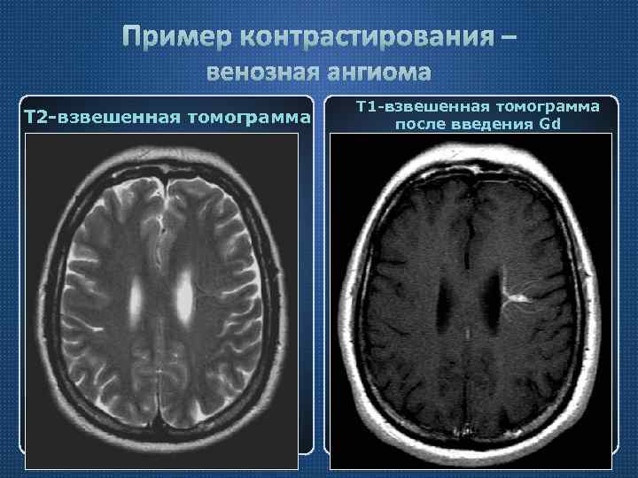 Пример контрастирования – венозная ангиома Т 2 -взвешенная томограмма Т 1 -взвешенная томограмма после