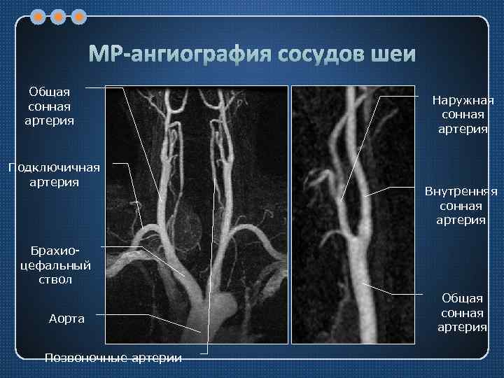 МР-ангиография сосудов шеи Общая сонная артерия Подключичная артерия Наружная сонная артерия Внутренняя сонная артерия