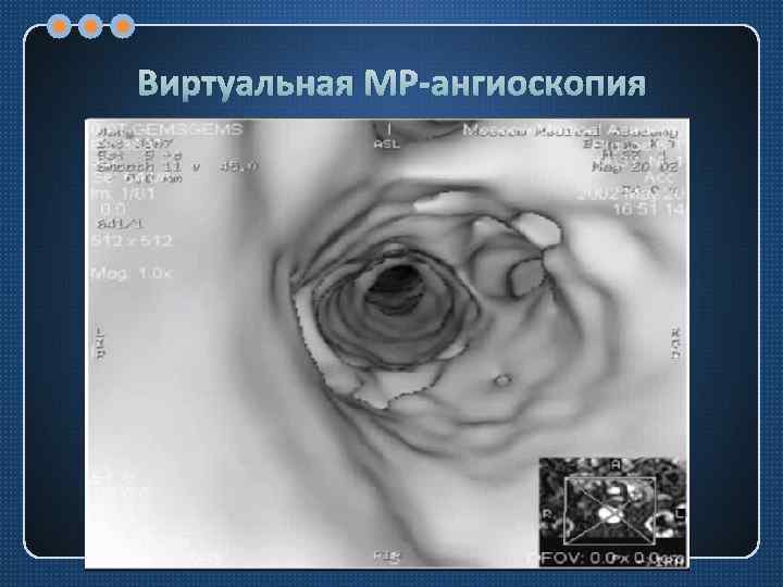 Виртуальная МР-ангиоскопия 
