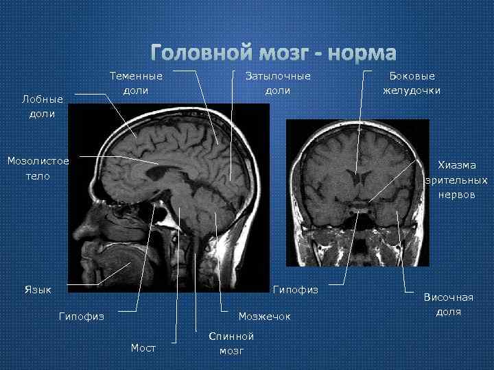 Головной мозг - норма Лобные доли Теменные доли Затылочные доли Мозолистое тело Боковые желудочки