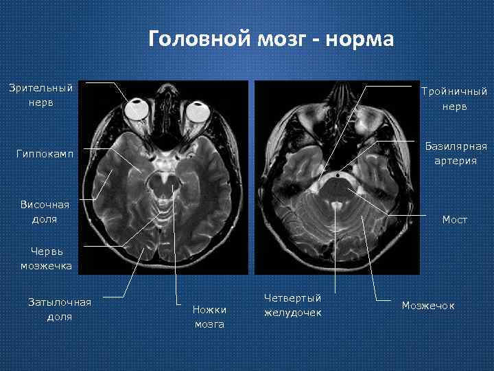 Головной мозг - норма Зрительный нерв Тройничный нерв Гиппокамп Базилярная артерия Височная доля Мост