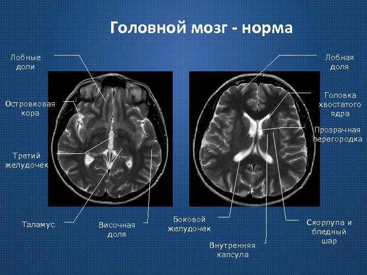 Головной мозг - норма Лобные доли Лобная доля Головка хвостатого ядра Островковая кора Прозрачная