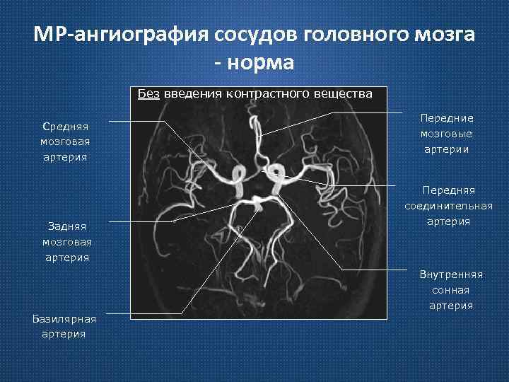 МР-ангиография сосудов головного мозга - норма Без введения контрастного вещества Средняя мозговая артерия Задняя