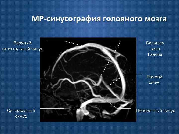 МР-синусография головного мозга Верхний сагиттальный синус Большая вена Галена Прямой синус Сигмовидный синус Поперечный