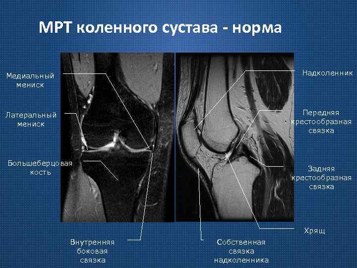 МРТ коленного сустава - норма Медиальный мениск Надколенник Латеральный мениск Передняя крестообразная связка Большеберцовая